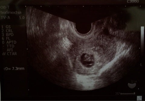 稽留流産ではなかった 8週ではじめて心拍確認 8w3d 奇跡 妊活 子育てブログ