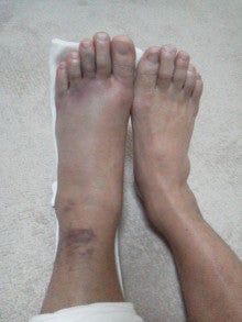 足 の 指 骨折 全治
