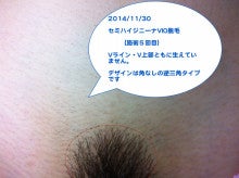 VIO脱毛（アンダーヘア）の形について：写真付2 痛くない脱毛でワンランク上の美人肌へ名古屋市脱毛専門店スキン