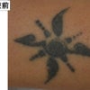 刺青に対するレーザー治療　２回治療後２ヶ月の画像
