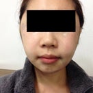 ID美容外科。日本人美容整形経験談。頬骨削り、エラ削り。韓国での輪郭手術でより女性らしく。の記事より