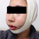 ID美容外科。日本人美容整形経験談。頬骨削り、エラ削り。韓国での輪郭手術でより女性らしく。の記事より
