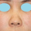４０代女性「鼻尖軟骨形成（鼻尖縮小+α法）」、手術直後の変化をご紹介します。の画像