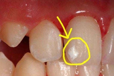 歯の一部が白く濁っている これって何 広島駅から徒歩４分 河村歯科クリニックのスタッフブログ インプラント ホワイトニング ヒアルロン酸注射 親知らずの抜歯ならお任せ