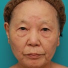 70代女性にミニフェイスリフト（頬のたるみ取り）を行い、頬や首のたるみを改善させた術前術後画像の記事より