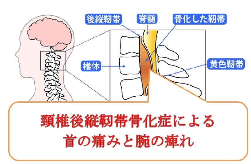 弘前市 頸椎後縦靭帯骨化症による首の痛みと腕の痺れを改善した症例 青森弘前市で唯一の体質改善整体 心も体も楽になる 青森弘前市石渡サンデーから徒歩2分 ーボディコンディショニングなるみ 弘前市 頸椎後縦靭帯骨化症による首の痛みと腕の痺れを改善した症例 青森弘前市で唯一の体質改善整体 心も体も楽になる 青森弘前市石渡サンデーから徒歩2分 ーボディコンディショニングなるみ