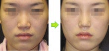 広い小鼻と低い鼻の手術 韓国fromb美容整形外科