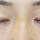 ２０代女性「切らない眼瞼下垂」手術後１２ヶ月目の変化をご紹介いたします。の記事より