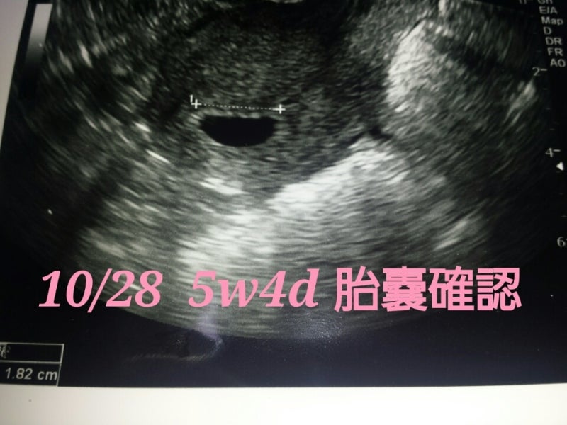 Bt 胎嚢大きさ 移植でhappyﾗｲﾌ 16 6月出産 18 8月出産