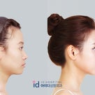 ID美容外科。角ばってないエラなのに大きく見える自分の顔の解決法は？エラ削り、頬骨削り、輪郭削りの記事より