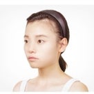ID美容外科。中国留学生ペイペイの手術ストーリ2。エラ削り、頬骨削り、輪郭削りの記事より