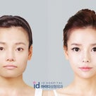 ID美容外科。中国留学生ペイペイの手術ストーリ3。エラ削り、頬骨削り、輪郭削りの記事より