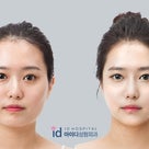 ID美容外科。「日本人体験談」輪郭手術経験談・レビュー。エラ削り、頬骨削り、輪郭削り、ルフォーの記事より