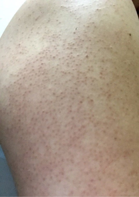 グルテン 毛孔性苔癬 二の腕のブツブツやザラザラ、これって何が原因なの？