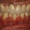 年齢とともに差し歯の歯茎が下がって黒く見えてきます。歯茎の審美歯科の紹介です。の画像