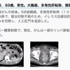 症例３；大腸がん、多発性肝転移、膀胱転移消失③ー免疫栄養ケトン食の画像