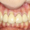 前歯の差し歯の歯茎が下がって黒く見えるのを治したいと考えている方はこちらをご覧ください。の画像