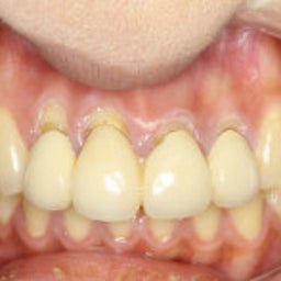画像 前歯の差し歯の歯茎が下がって黒く見えるのを治したいと考えている方はこちらをご覧ください。 の記事より 1つ目