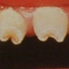 ハッチンソン歯・・・先天性の梅毒がもたらす歯の形成不全の画像