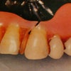 入れ歯が壊れたので、修理して欲しいのですが・・・京都、山科で入れ歯を修理してくれる歯科医院の画像