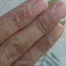 私の手荒れ、手湿疹を克服した方法はコレ！の記事より