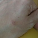 私の手荒れ、手湿疹を克服した方法はコレ！の記事より