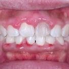 20歳　女性　上顎前突＆凸凹が主訴　小臼歯4本抜歯の治療が終了しました。の記事より