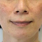 51歳　女性　上顎前突と凸凹が主訴　小臼歯4本抜歯で治療が終了しました。の記事より