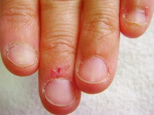 深爪矯正 ピンクの部分が伸びるだけでなく形が変わります 深爪 巻爪矯正専門店 初回施術で爪の食い込み広げ痛みが取れる 03 6453 9212