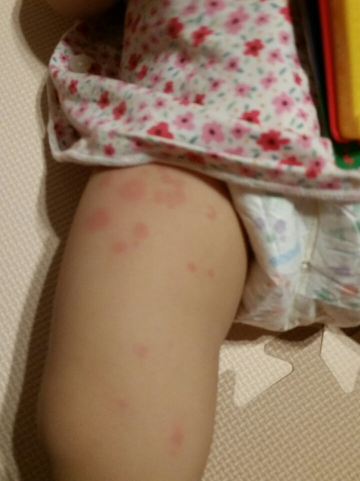 蕁麻疹 ありすの育児日記