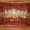 あなたの差し歯のセラミックの透明感はどうしたいでしょうか？の画像