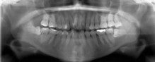 28歳　女性　凸凹が主訴　小臼歯4本抜歯にての治療が終了しました。の記事より