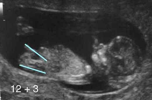 12週からの性別判定baby Nubとは 産み分けの成功率をあげる方法
