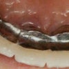 「ジルコニアオールセラミック」・・・最高品質の「割れにくい歯科用セラミック」が最安値 で・・・の画像