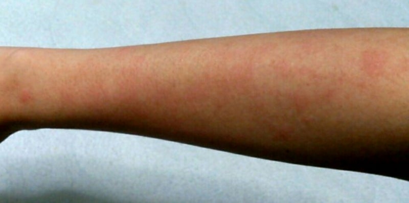 日光アレルギー 紫外線アレルギーの13の症状と2大原因とは？完治しないってホント？