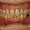 差し歯の長さを短くしたい方のための審美歯科治療の画像