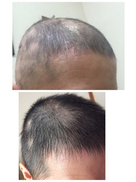 私のひまし油使用法 日本毛髪科学協会 毛髪診断士 認定講師 サラの脱毛症完治 再発 のブログ ﾟ