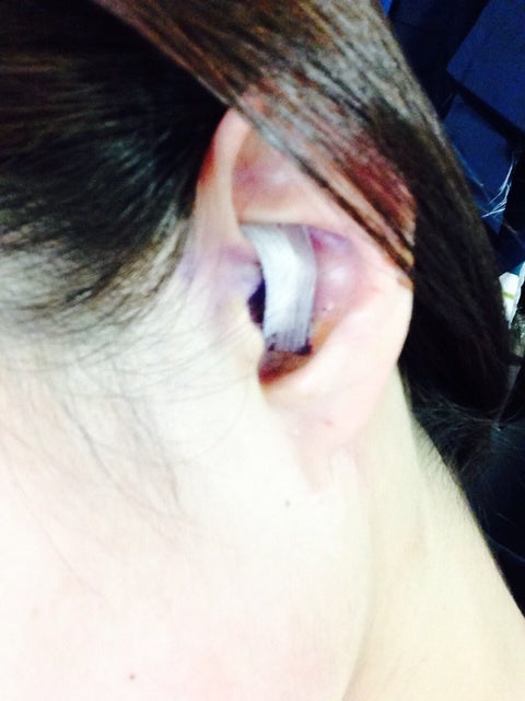 耳 瘻孔 手術 費用