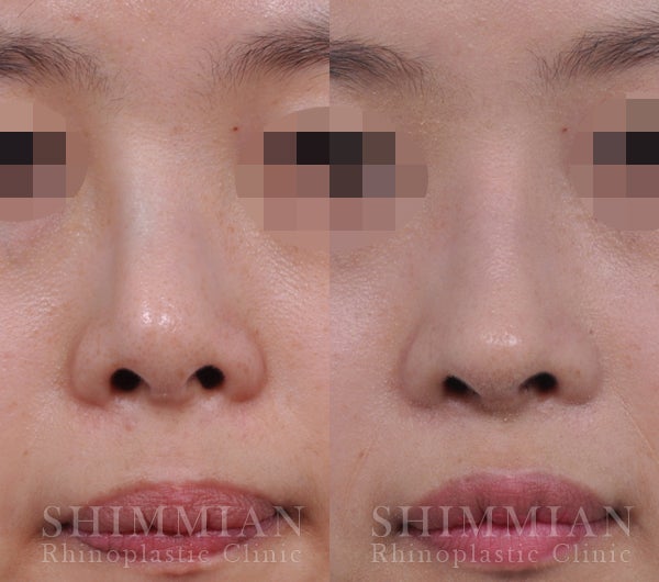 曲がった鼻の矯正 韓国シンミアン整形外科