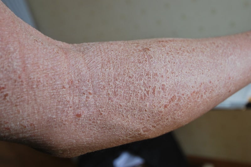 大人 皮膚 アトピー 性 炎 大人アトピー性皮膚炎・アレルギーがたった1年で改善！