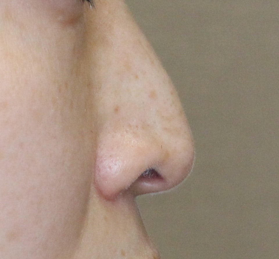 症例写真　耳介軟骨移植後１ヶ月の記事より