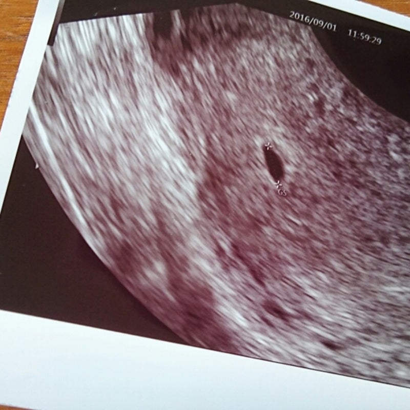 初診 5週0日 妊娠 妊娠5週目 胎嚢の大きさ・エコー写真、つわり症状や流産のこと