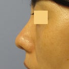 Ｌ型プロテーゼを抜去したときの鼻尖形成：耳介軟骨による鼻翼軟骨の補強と移植の記事より