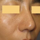 Ｌ型プロテーゼを抜去したときの鼻尖形成：耳介軟骨による鼻翼軟骨の補強と移植の記事より