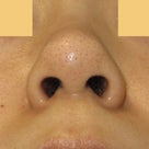 団子鼻：鼻尖縮小術と耳介軟骨移植による鼻先の治療　術後2週間　の記事より