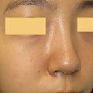団子鼻：鼻尖縮小術と耳介軟骨移植による鼻先の治療　術後2週間　の記事より