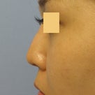 鼻尖形成術：鼻尖を高く、斜め下方に向ける　術後2週間の記事より