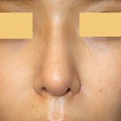 鼻尖形成術：鼻尖を高く、斜め下方に向ける　術後2週間の記事より