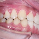 16歳　男性　顎関節痛が主訴　非抜歯（親知らずは抜歯）による治療が終了しました。の記事より