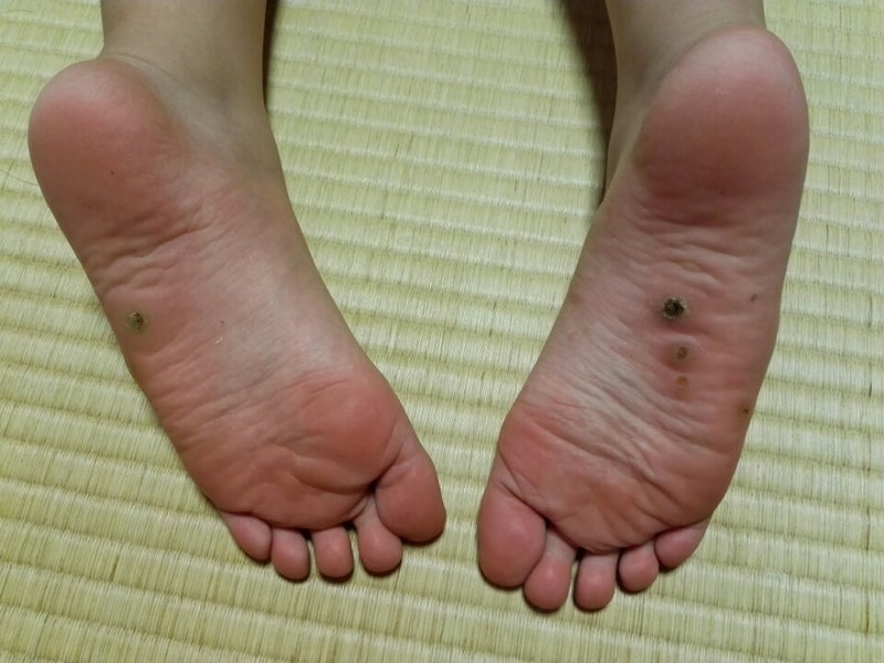 足底疣贅 足の裏のイボにお灸 ようこそ日記 石川県羽咋市 松田鍼灸治療院